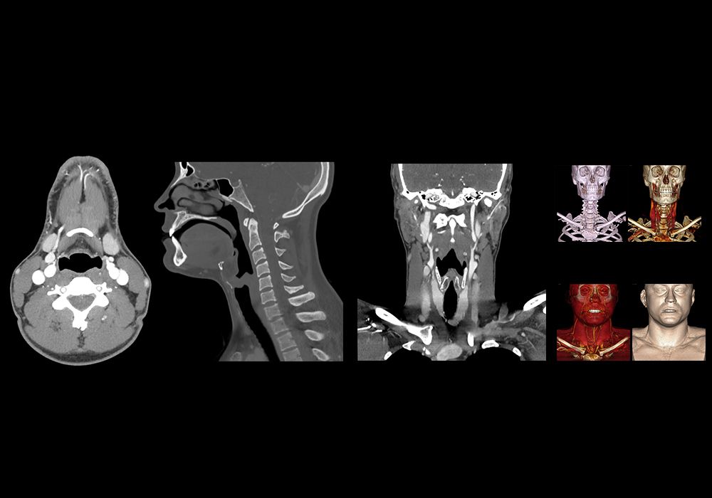 CT scan of head and neck: normal anatomy | e-Anatomy