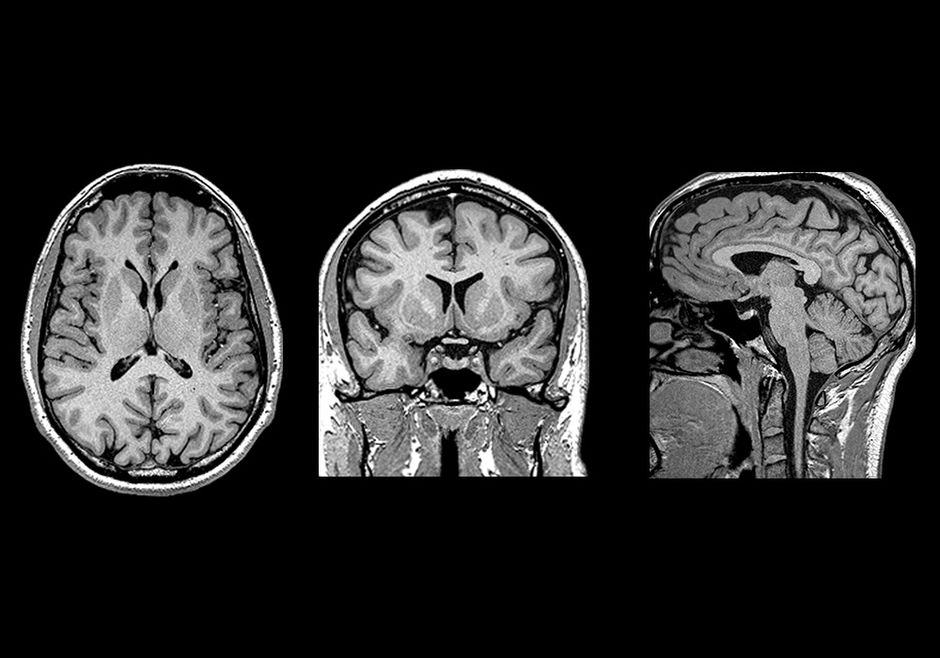 Cerveau IRM 3D : anatomie normale | e-Anatomy