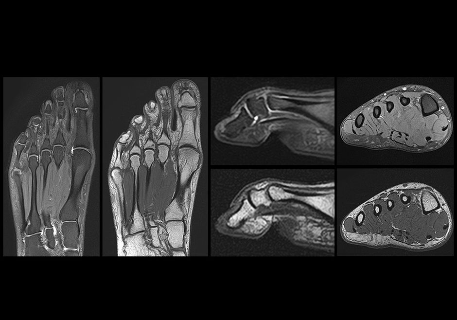 Anatomy of the midfoot, forefoot and toes: annotated MRI | e-Anatomy